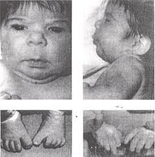 phenytoin syndrome