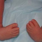 club foot