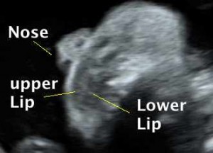Nose and lips coronal 2D web