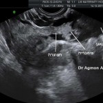salpinx floating in pelvis