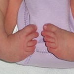 clubfoot uri1