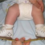 denis splint